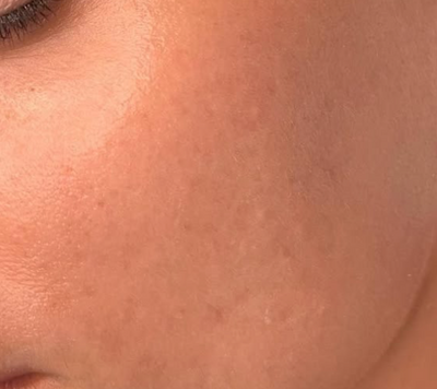 Visible Improvement Smoother Cheeks